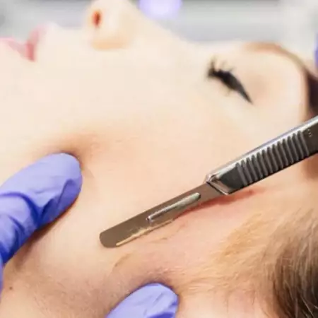 dermaplaning-huidverbetering-gezichtsverzorging-Mani-E-Piedi-Nieuwpoort-Schoonheidsinstituut-huidverbetering